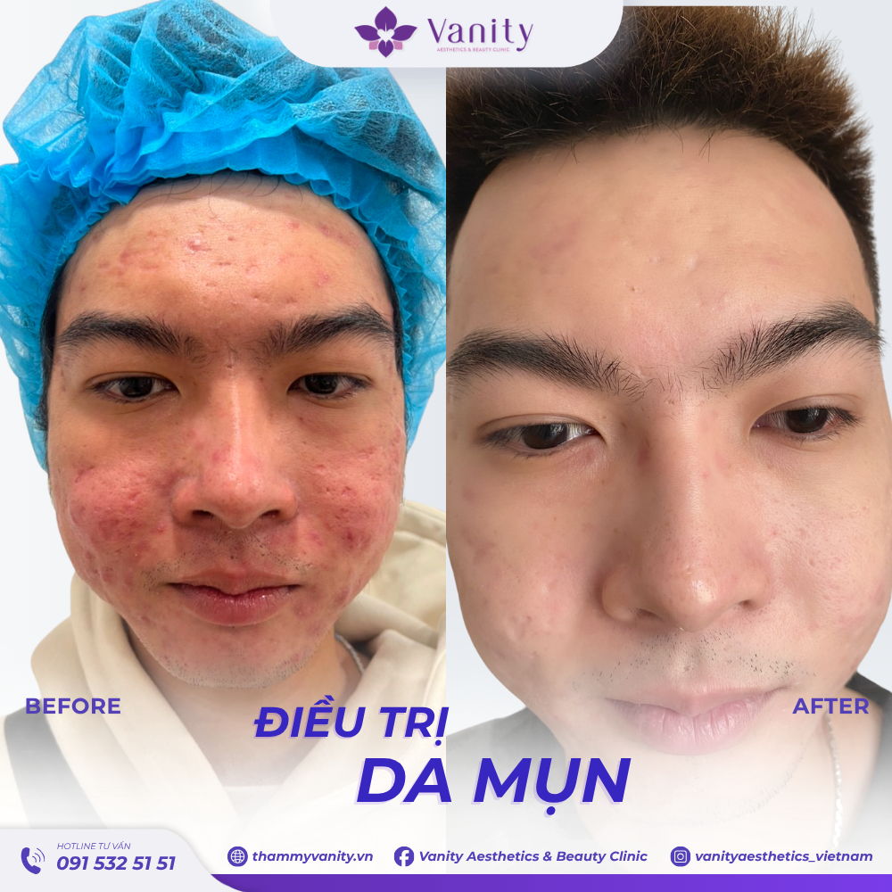 ĐIỀU TRỊ DA MỤN